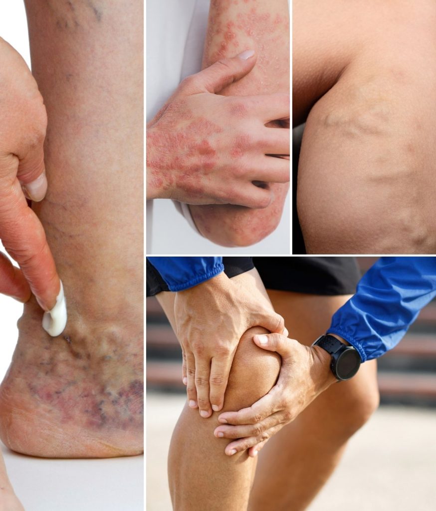 Varicose veins, muscle pain, sore muscles, tired legs.