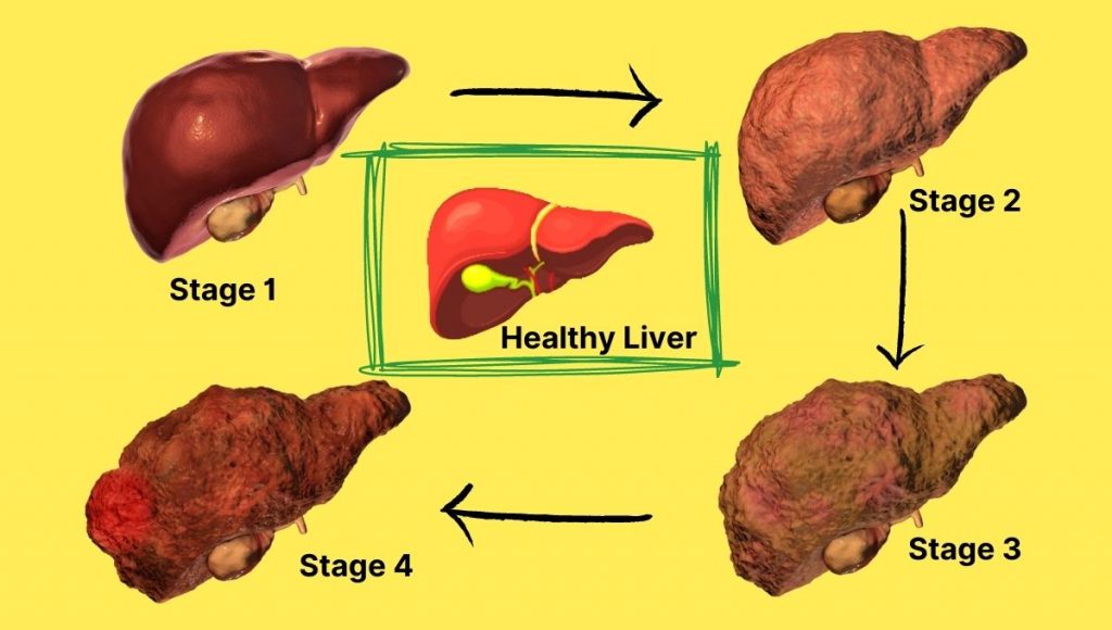 Different Stages of Liver Disease.